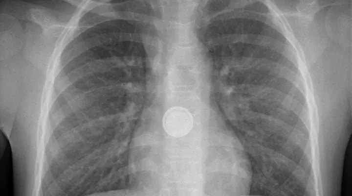 Röntgenbild des Oberkörpers, eine Knopfbatterie befindet sich im Brustkorb.