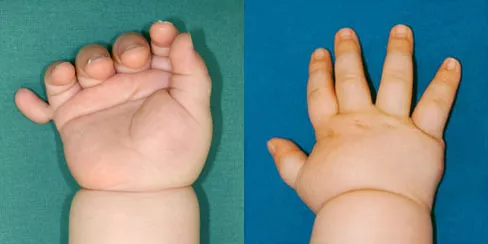 Handchirurgie: Beispiel für Polydaktylie mit 6 Fingern, prä- und postoperativ